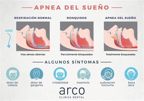 APNEA DEL SUEÑO.